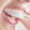 Clear Aligners