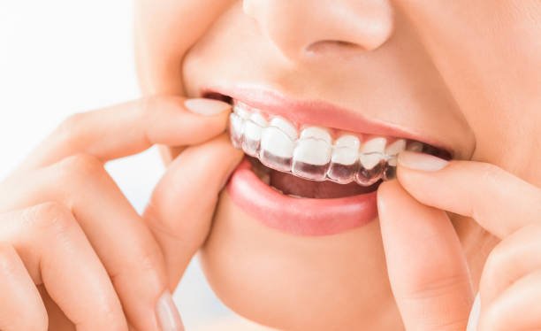 Accualigners Clear aligners in UK