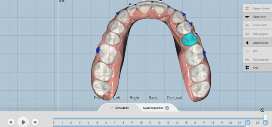 aligner treatment
